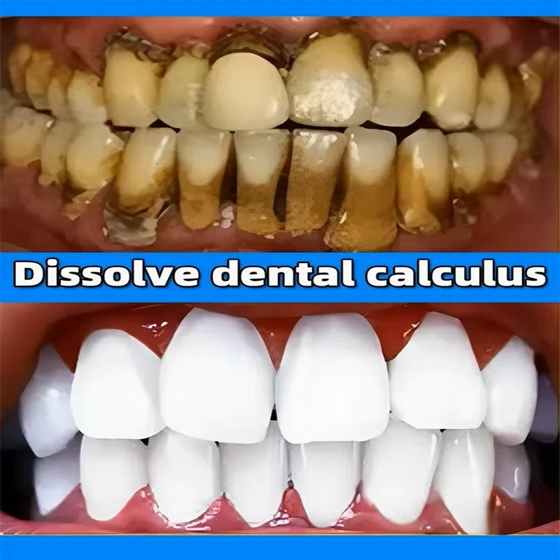 Dental Calculus Remover, Bad Breath Teeth Toothpaste Brightening