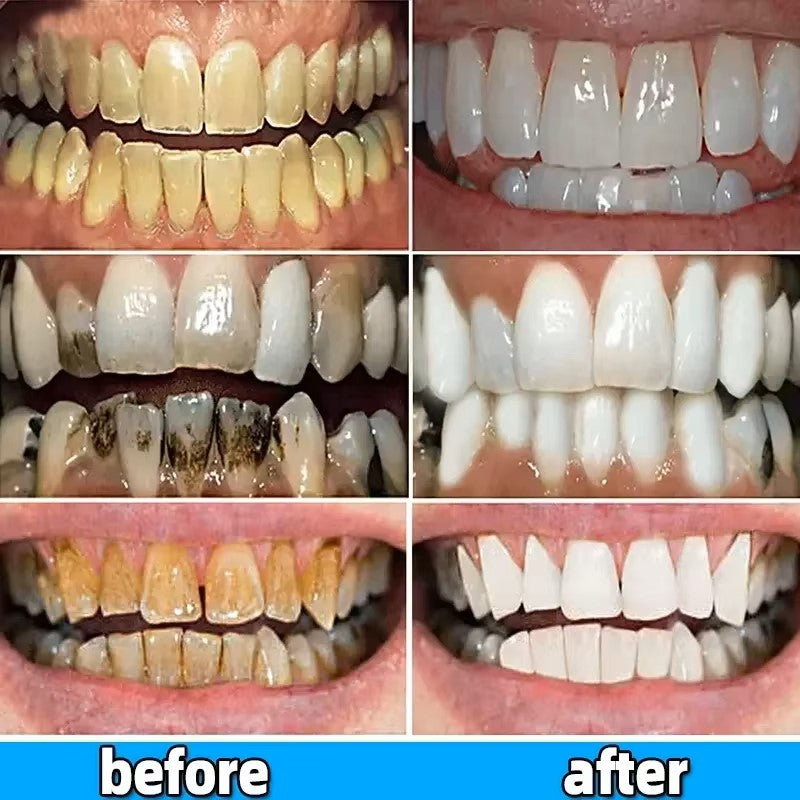 Dental Calculus Remover, Bad Breath Teeth Toothpaste Brightening